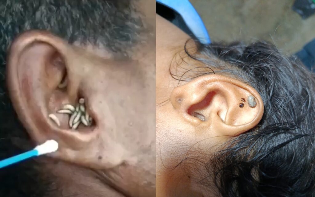 Médico de Sabanalarga extrae garrapatas y gusanos de oídos humanos en casos médicos poco comunes.